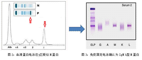 肝,肾疾病和多发性骨髓瘤的敏感诊断方法 ——血清蛋白电泳及免疫固定
